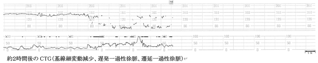 約2時間後のCTG（基線細変動減少、遅発一過性徐脈、遷延一過性徐脈）